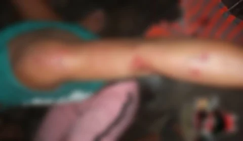 Jacaré ataca jovem durante banho em rio de Manicoré; confira