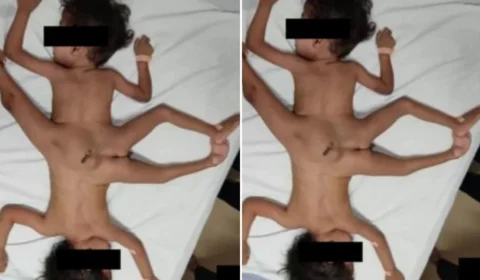 Médicos dão veredito sobre cirurgia de gêmeos siameses com 3 pernas