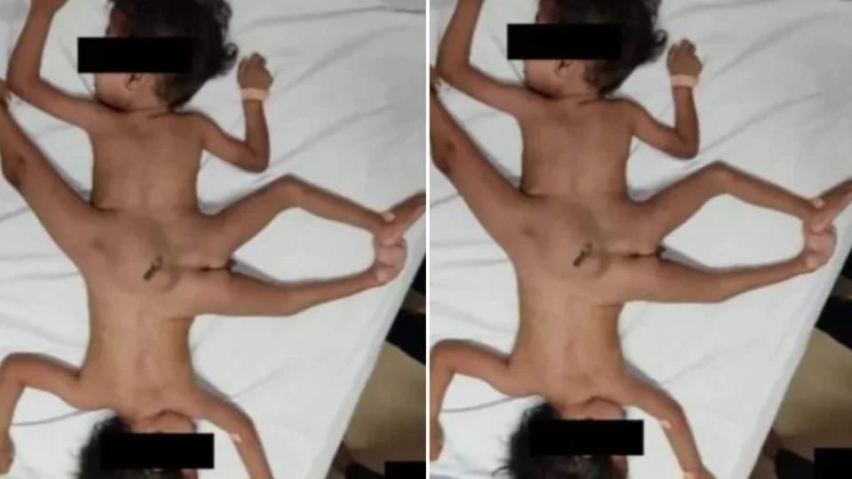 Médicos dão veredito sobre cirurgia de gêmeos siameses com 3 pernas