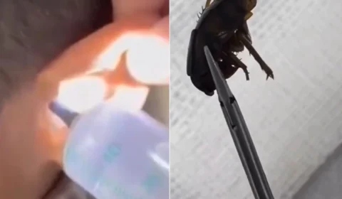 VÍDEO: médico retira barata e sementes de melancia do ouvido de criança