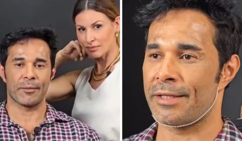 Web critica antes e depois de harmonização facial: ‘não precisava’