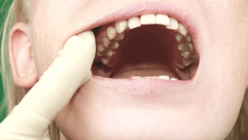 Câncer de boca cresce entre os mais jovens; entenda