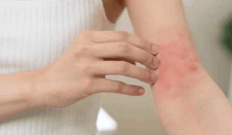 Amazonas registra 428 casos confirmados de esporotricose, diz FVS