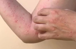 Mpox: Comitê de emergência será criado pelo Ministério da Saúde