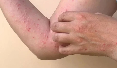 Mpox: Amazonas registra 67 casos; veja como reduzir riscos de infecção