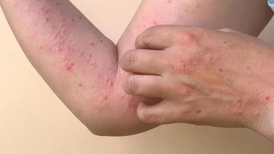 Mpox: Comitê de emergência será criado pelo Ministério da Saúde