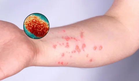 Mpox: novos casos da doença são registrados no Paquistão; veja