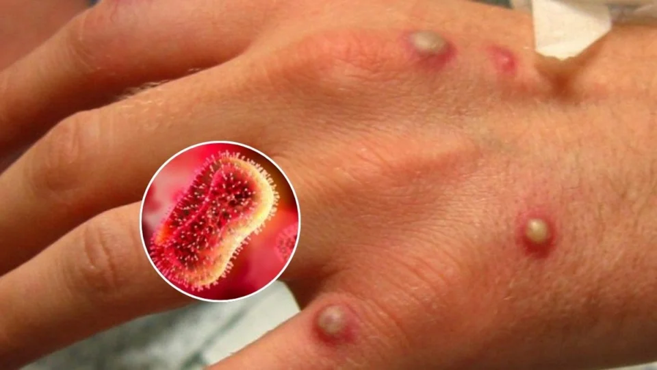 Mpox: confira os sintomas e as medidas para prevenir a infecção