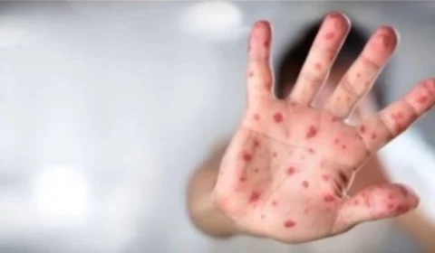 Mpox: saiba o que mudou do surto de 2022 para o atual