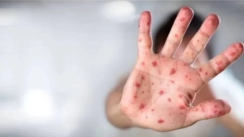 Brasil tem mais de 1,6 mil casos de ‘varíola dos macacos’ em 2024