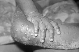 Mpox no Amazonas: cresce o número de notificações mesmo sem novos casos confirmados