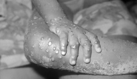 Mpox no Amazonas: cresce o número de notificações mesmo sem novos casos confirmados