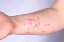 Mpox no Amazonas: estado apresenta aumento de notificações e casos; saiba como se proteger