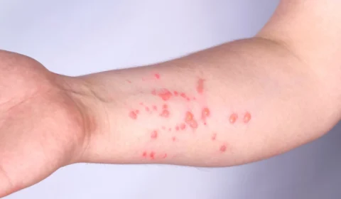 Mpox: Brasil bate recorde de 1000 casos confirmados