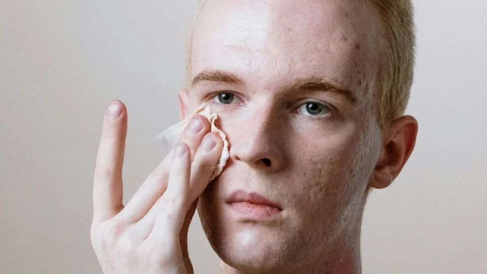 Manchas de acne: quatro dicas para remover as marcas de espinhas