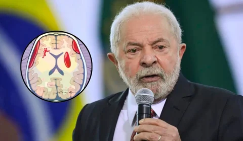 Hematoma cerebral: saiba o que é a condição que fez Lula cancelar viagem à Rússia