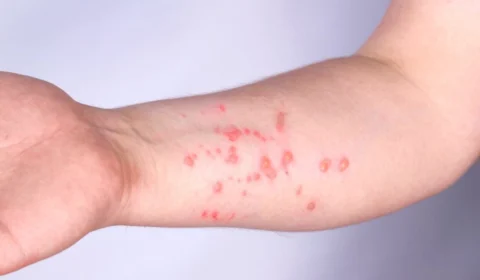 Com 33 casos confirmados, Mpox volta a ser registrada no DF