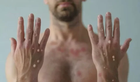 Painel de Mpox monitora casos da doença; veja quais estados lideram