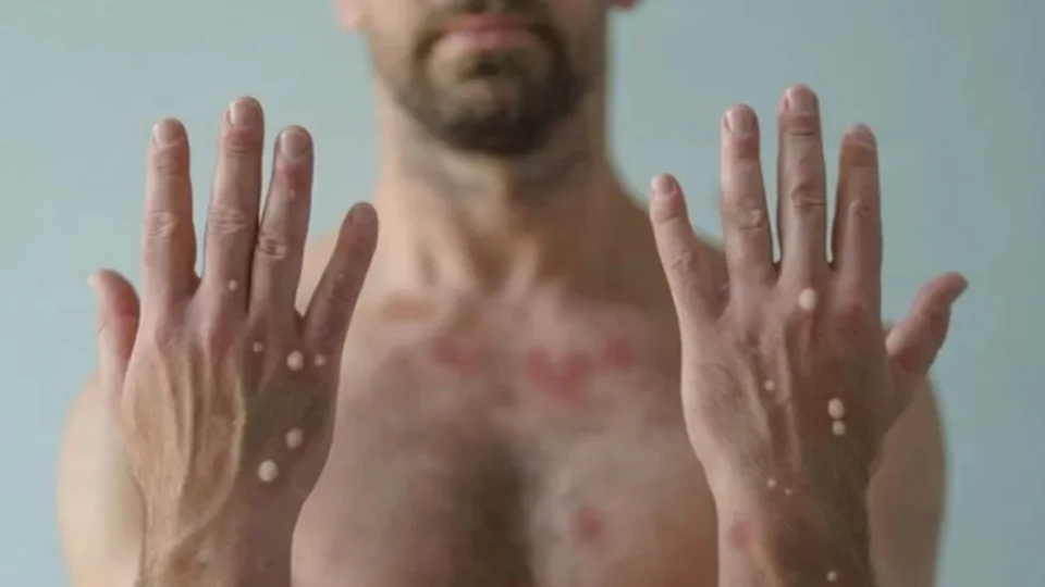 Mpox continua sendo emergência global em saúde pública, diz OMS