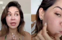 PMMA: saiba quais são os riscos da substância que causou inchaço no rosto de Maíra Cardi