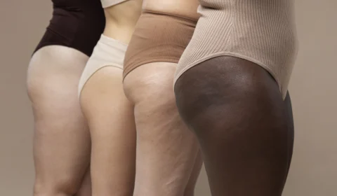 Como reduzir celulite? 4 dicas infalíveis para cuidar da sua aparência