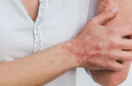 Casos de esporotricose humana crescem nos últimos 6 meses no Amazonas