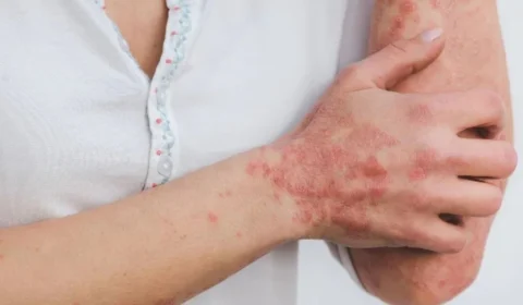 Casos de esporotricose humana crescem nos últimos 6 meses no Amazonas