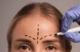 Como reduzir a testa? Tudo que você precisa saber sobre a frontoplastia