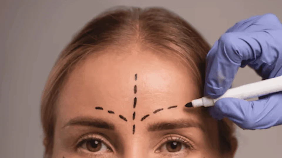 Como reduzir a testa? Tudo que você precisa saber sobre a frontoplastia