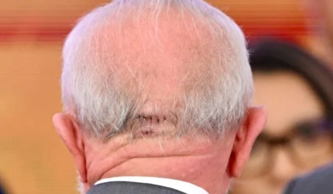 Lula internado: entenda o que é craniotomia, cirurgia feita pelo presidente