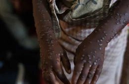 Casos de ‘varíola dos macacos’ aumentam no Amazonas, segundo dados da FVS-AM