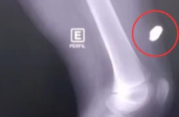 Criança é atingida por bala perdida dentro de casa, em Itacoatiara; vítima estava dormindo