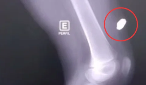 Criança é atingida por bala perdida dentro de casa, em Itacoatiara; vítima estava dormindo