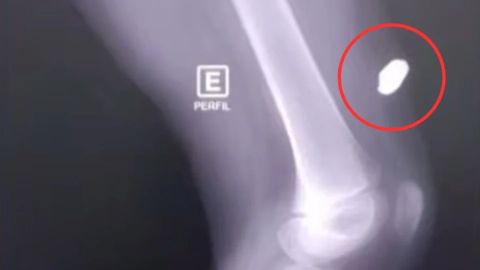 Criança é atingida por bala perdida dentro de casa, em Itacoatiara; vítima estava dormindo