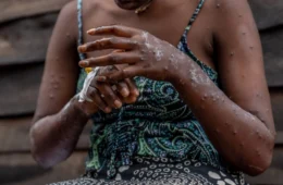 URGENTE: Saúde confirma primeiro caso de nova cepa de mpox no Brasil