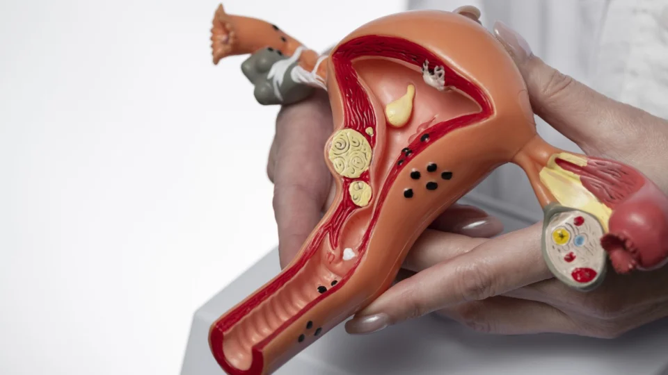 Endometriose tem cura? O que toda mulher precisa saber sobre os sintomas, causas e tratamentos