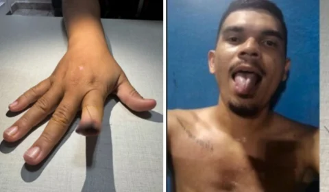 Homem ataca e arranca dedo de namorada em surto de ciúmes em Manaus