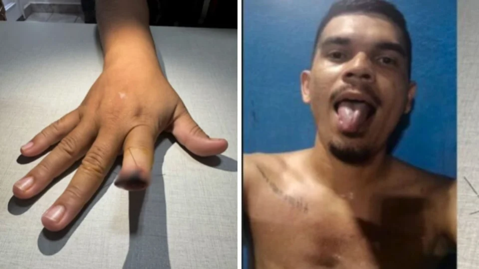 Homem ataca e arranca dedo de namorada em surto de ciúmes em Manaus