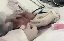 Gêmeas siamesas nascidas em Manaus passam por cirurgia de separação em Goiás; veja estado de saúde