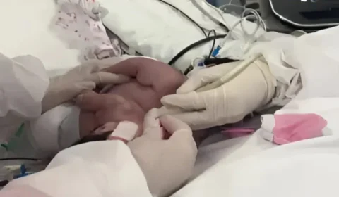 Gêmeas siamesas nascidas em Manaus passam por cirurgia de separação em Goiás; veja estado de saúde