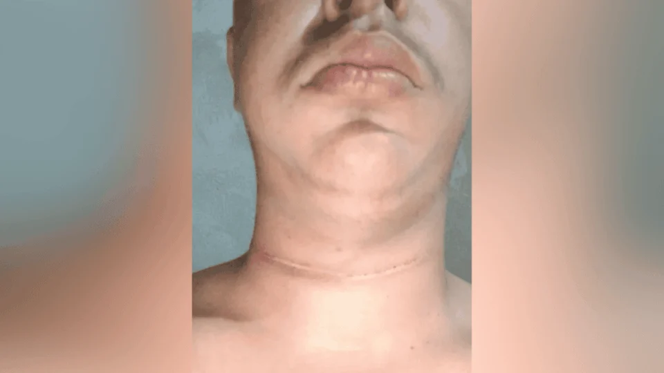 Entregador quase morre degolado por linha de pipa com cerol em avenida movimentada no AC