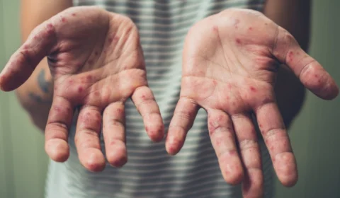 Tocantins confirma nove casos de sarampo