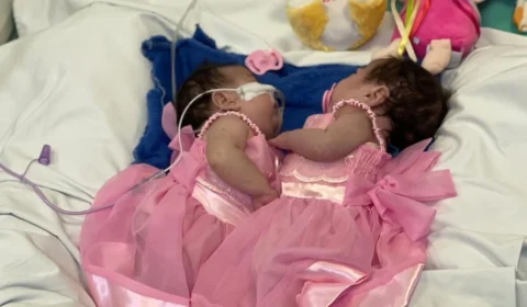 Entenda procedimento de ‘separação’ das gêmeas siamesas do Amazonas