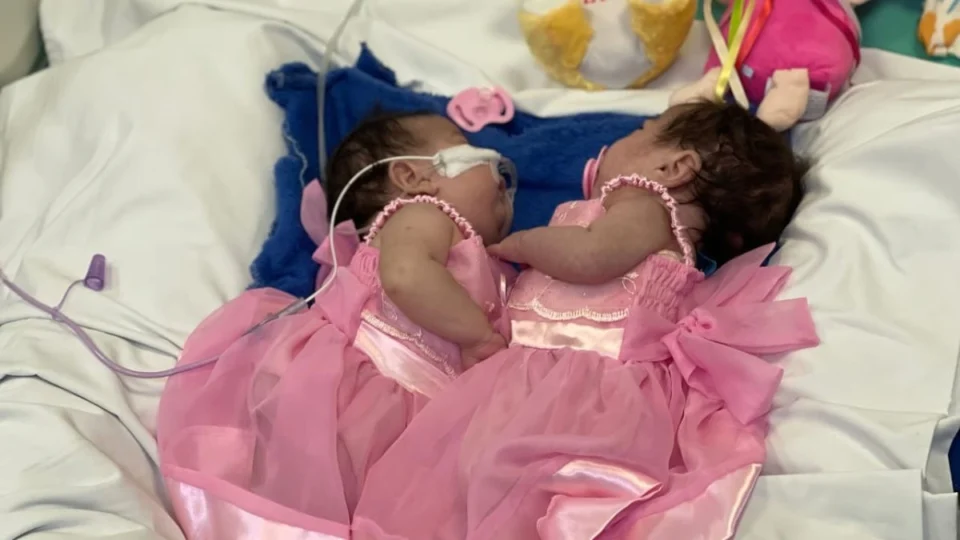 Entenda procedimento de ‘separação’ das gêmeas siamesas do Amazonas