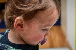 Sarampo coloca Norte em alerta: Rondônia investiga caso suspeito