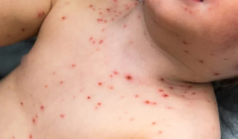 Sarampo no Tocantins: criança e profissional de saúde que não foram vacinados testam positivo, diz Secretaria