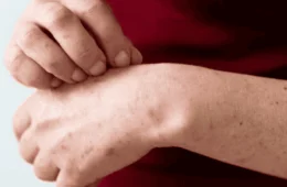 SES-TO alerta para avanço do sarampo e reforça a importância da vacinação