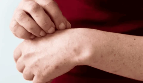 SES-TO alerta para avanço do sarampo e reforça a importância da vacinação