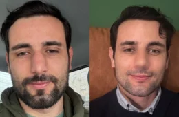 VÍDEO: ex-BBB Matteus Amaral mostra resultado de rinoplastia