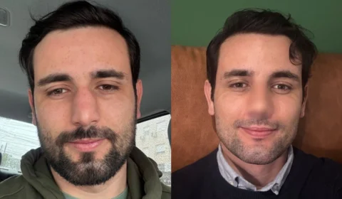 VÍDEO: ex-BBB Matteus Amaral mostra resultado de rinoplastia